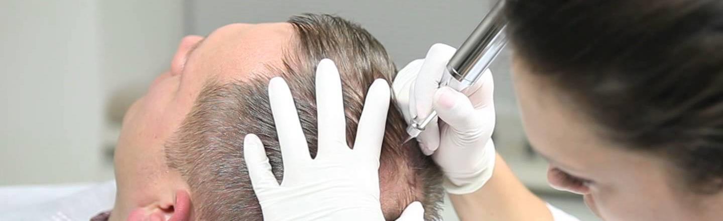 SCALP MICROPIGMENTATION